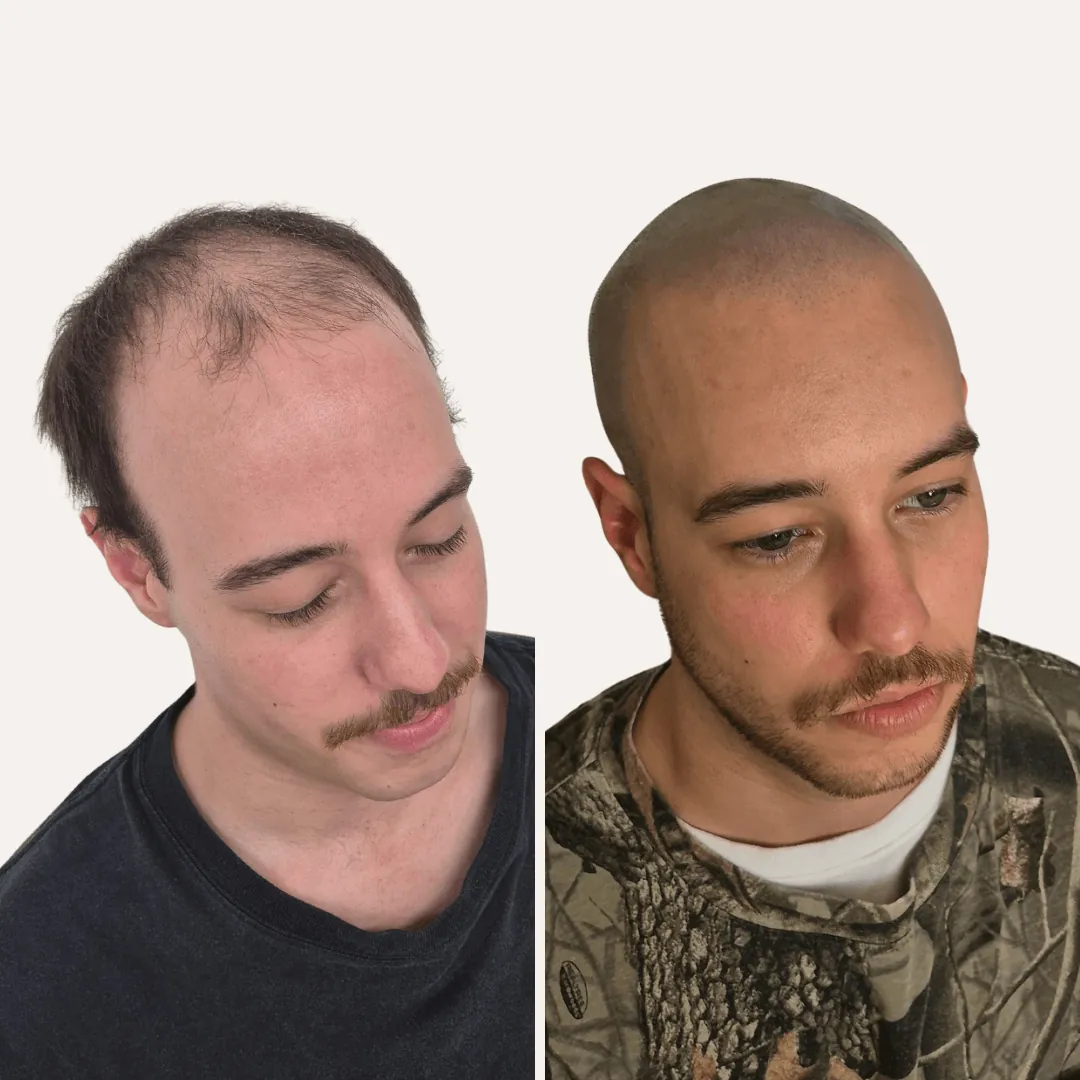 Receding hairline before and after SMP creating the appearance of shaved hair