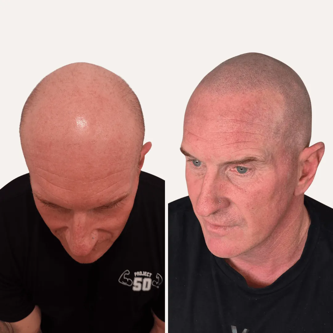 Bald client before and after SMP for a clean shaved look
