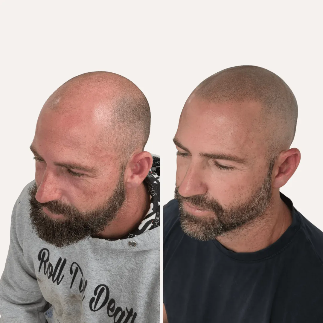 Bald man before and after scalp micropigmentation creating a natural shaved hairline