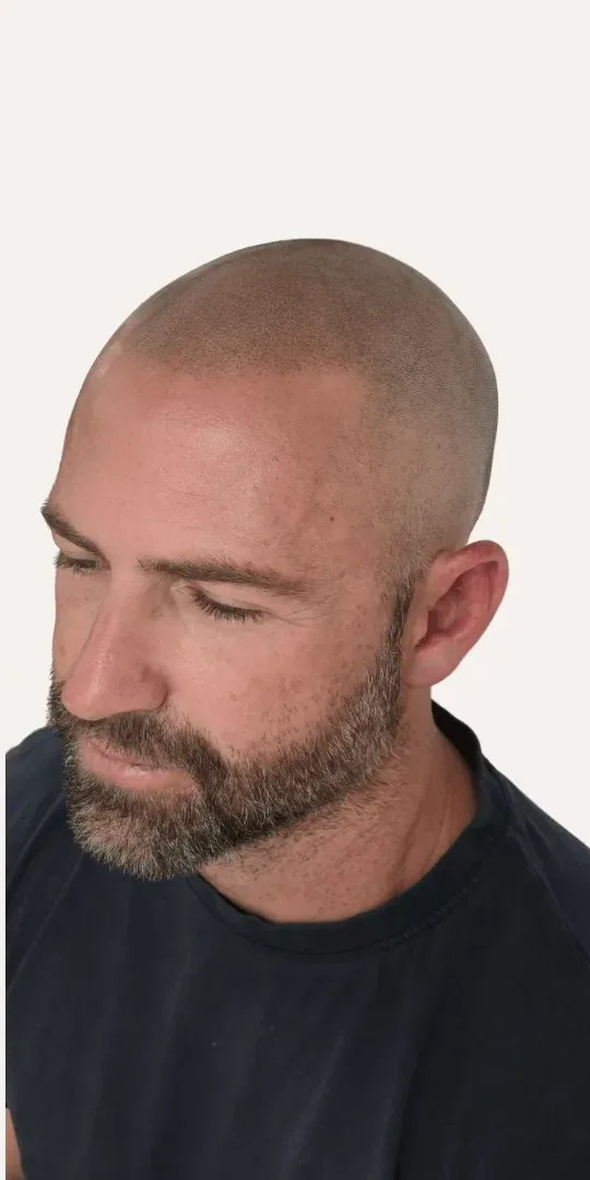 After: bald client given a natural shaved look with scalp micropigmentation