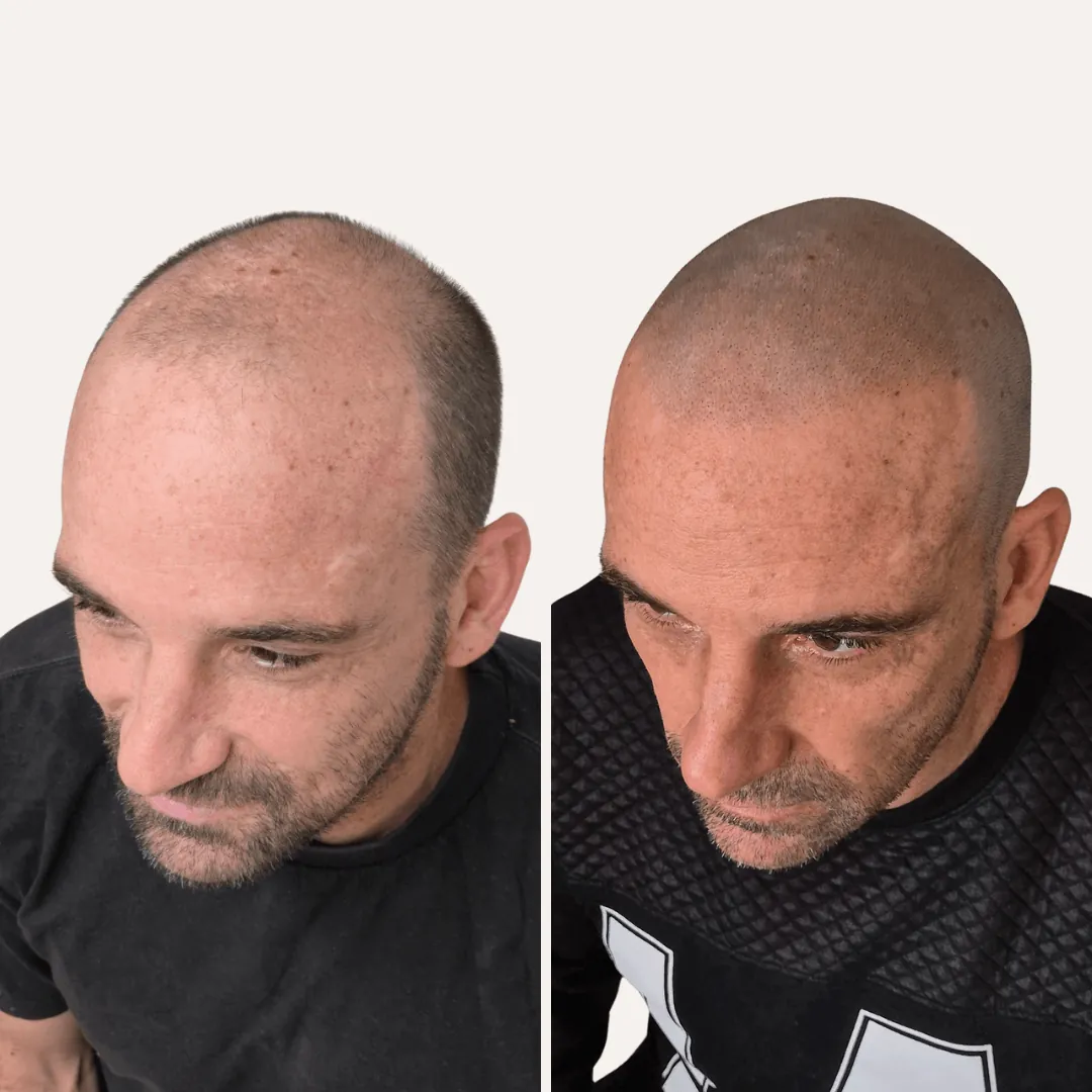 Natural scalp micropigmentation result on a fully bald client, before and after