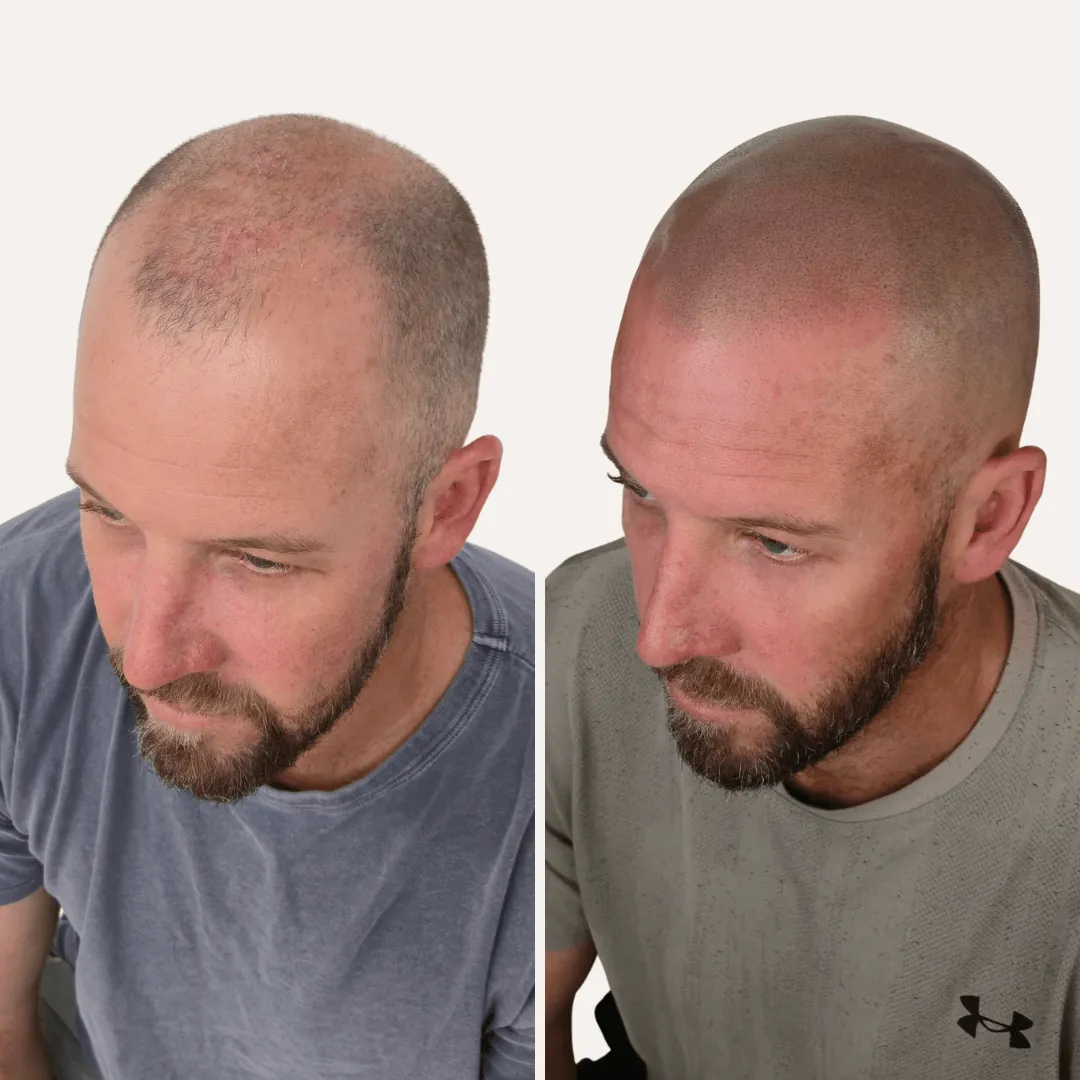 Scalp micropigmentation for a bald man wanting a clean shaved look, before and after