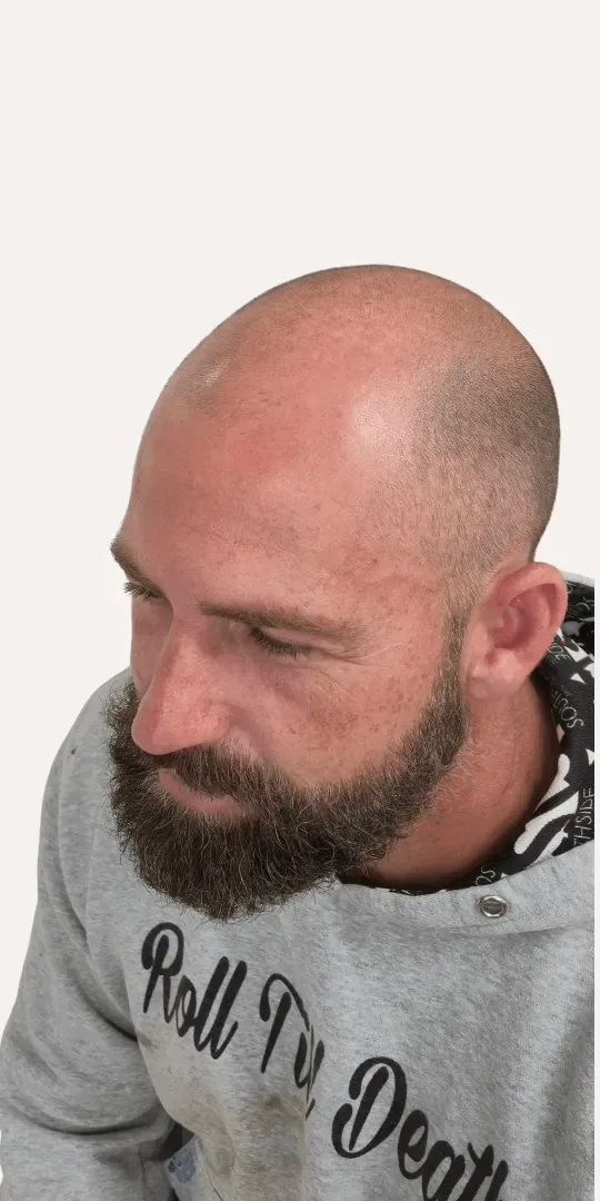 Before: bald client given a natural shaved look with scalp micropigmentation