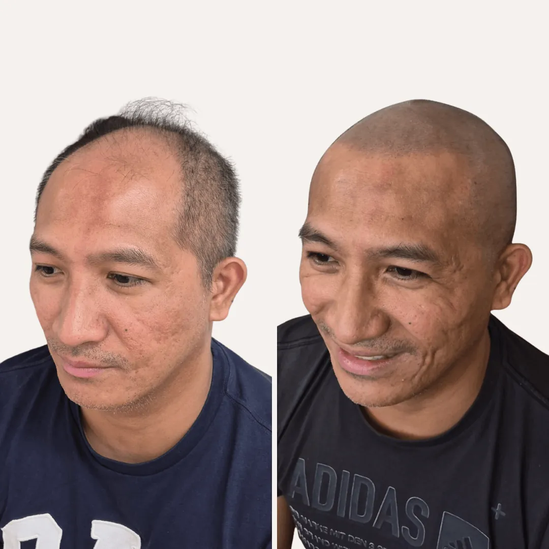 Bald man before and after SMP with a natural shaved hairline